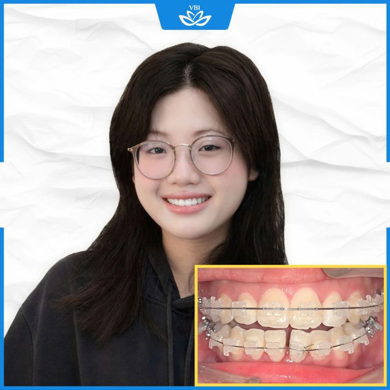 Niềng răng mắc cài Sứ