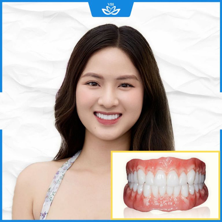 Răng sứ thẩm mỹ