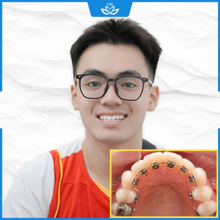 Niềng mắc cài mặt lưỡi