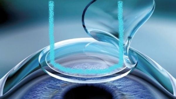 LASIK - LASER ASSISTED IN SITU KERATOMILEUSIS