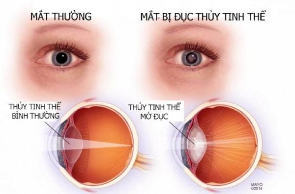 PHACO - Vui sống cùng đôi mắt sáng rõ