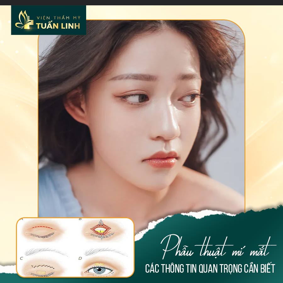 Phẫu thuật mí mắt