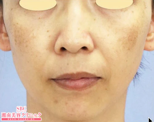 Điều trị nám, tàn nhang